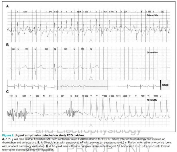 新研究表明 Apple  Watch  还能检测其他类型的心律不齐插图3