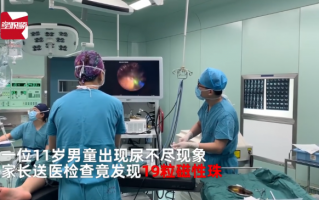 男孩膀胱塞入19粒磁珠1年后取出，都是好奇惹的祸，一直没说告知家长