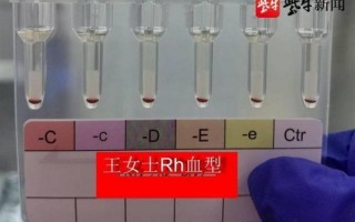 江苏发现2例罕见黄金血型 全球不足50例：被称万能血型 适配任何人