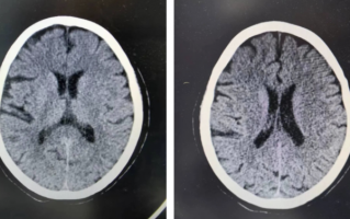 女子突发脑梗 及时溶栓转危为安 脑卒中患者约80%为脑梗死需要及时治疗