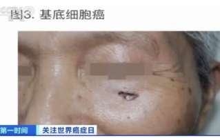 紧急提醒！这种癌症，发病率高！极易被忽视 一定要多注意及时发现治疗