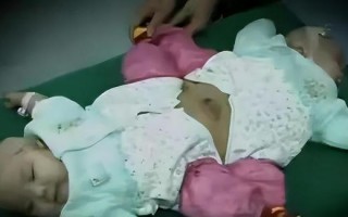 夫妻连生两胎均患怪病性别难辨：彼比相连共用一个排泄系统