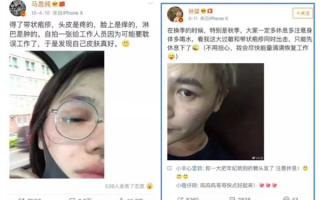 让马思纯“半毁容”的皮肤病有多疼：可以痛到比肩生孩子