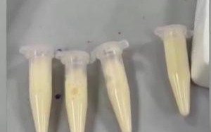 孕妇每天1杯奶茶喝成“奶茶血” 血浆变成“奶白色”