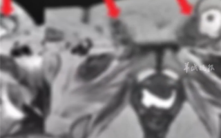 女子连续3年每月痛经15天以为没事：确诊罕见疾病