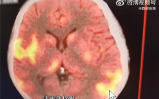 女子发烧一周不在意昏迷2个月 医生：脑部像燃起了熊熊大火