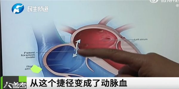 29岁小伙多个“心眼”致间断头疼20年：每4个成人就有1个患此病-第1张图片-9158手机教程网