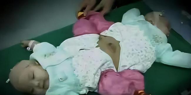 夫妻连生两胎均患怪病性别难辨：彼比相连共用一个排泄系统-第1张图片-9158手机教程网