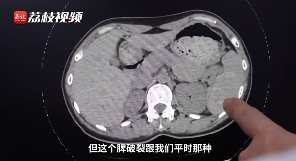 女子摔伤一周后发现脾破裂险丧命：当初认为摔岔了气-第3张图片-9158手机教程网