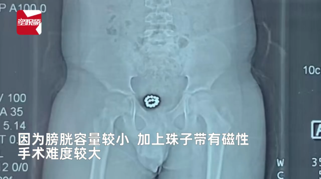 男孩膀胱塞入19粒磁珠1年后取出，都是好奇惹的祸，一直没说告知家长-第4张图片-9158手机教程网