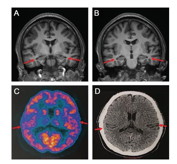 医生发现19岁阿尔兹海默症患者 已知最年轻患者 医生称检查时一度不敢相信-第1张图片-9158手机教程网