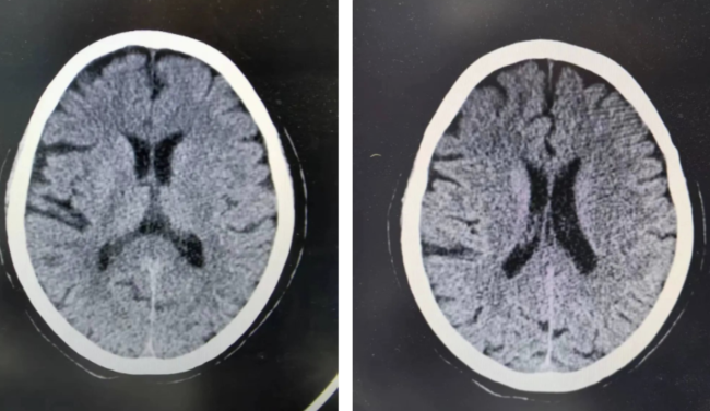 女子突发脑梗 及时溶栓转危为安 脑卒中患者约80%为脑梗死需要及时治疗-第1张图片-9158手机教程网