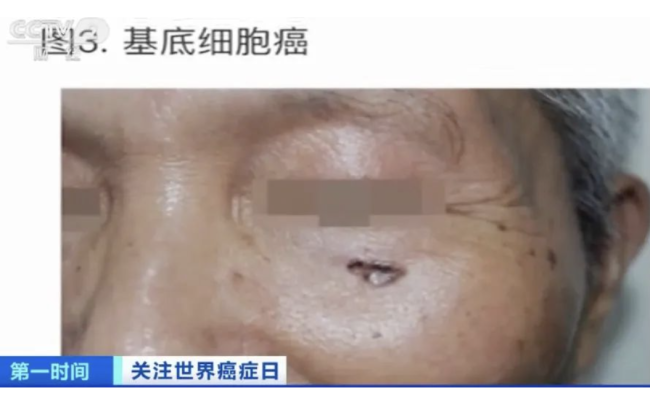 紧急提醒！这种癌症，发病率高！极易被忽视 一定要多注意及时发现治疗-第1张图片-9158手机教程网