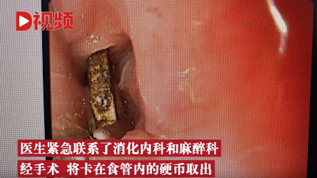 2岁娃咳嗽50天查出硬币卡喉 网友:这家长心真大-第3张图片-9158手机教程网 2岁娃咳嗽50天查出硬币卡喉 网友:这家长心真大-第3张图片-9158手机教程网