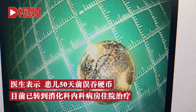 2岁娃咳嗽50天查出硬币卡喉 网友:这家长心真大-第4张图片-9158手机教程网 2岁娃咳嗽50天查出硬币卡喉 网友:这家长心真大-第4张图片-9158手机教程网