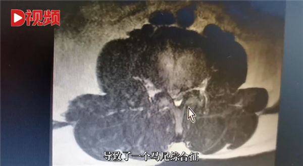 连续开车8小时！男子长期久坐后被诊断截瘫 医生提醒-第2张图片-9158手机教程网